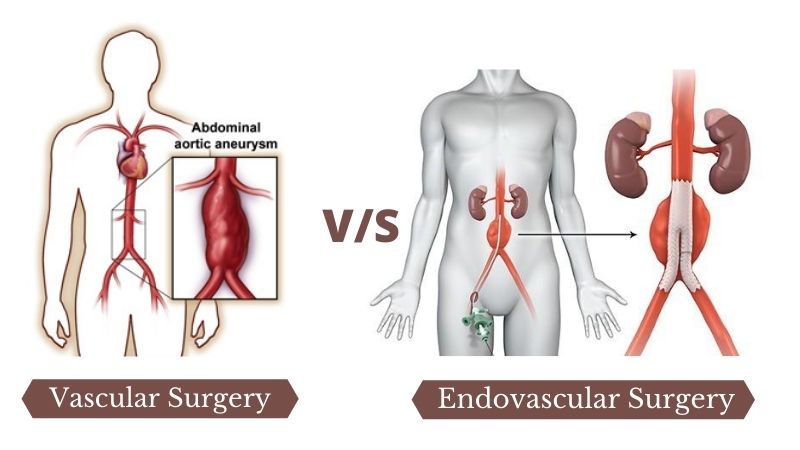 What is the Difference between Vascular and Endovascular Surgery?